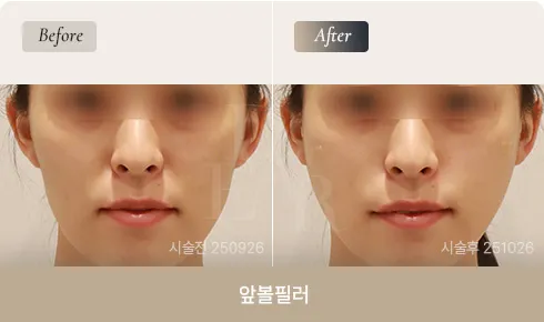 front-cheek-filler-bna-03