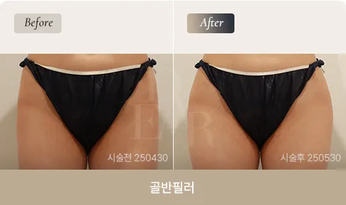 pelvic-filler