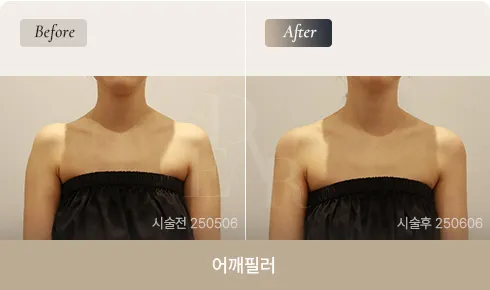 shoulder-filler-01-fin
