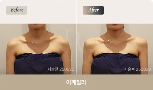 shoulder-filler-03