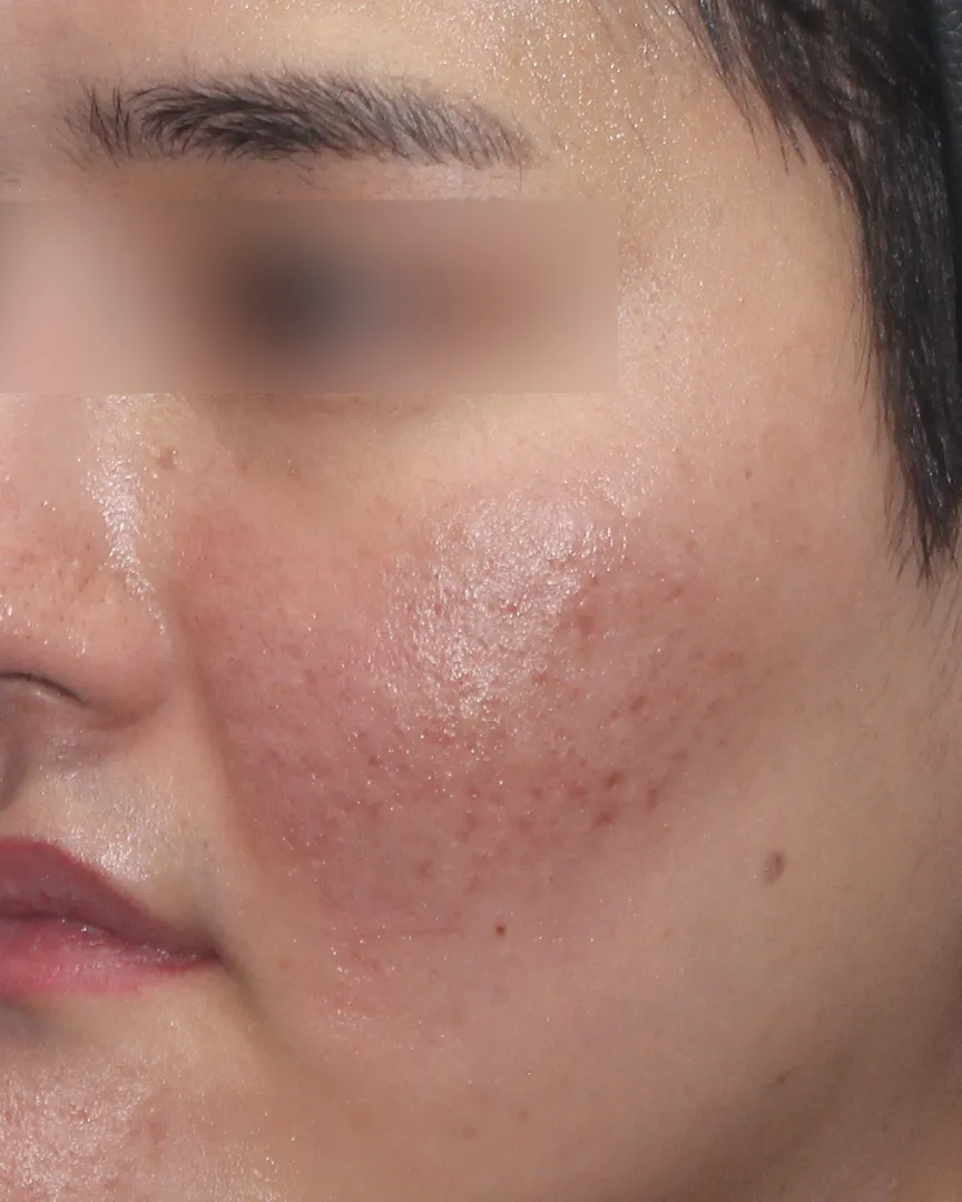 Cheongdam Dear_Scar Treatment_Before