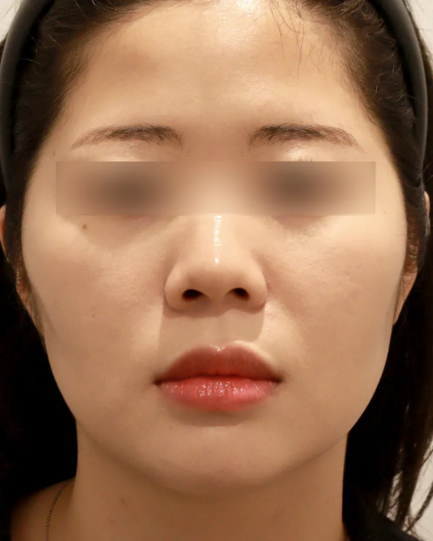 청담디어_옆볼필러_전
